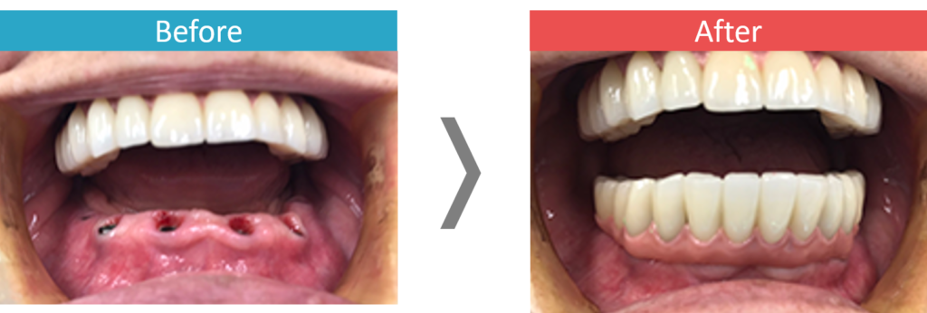 下顎のオールオン4治療の症例写真